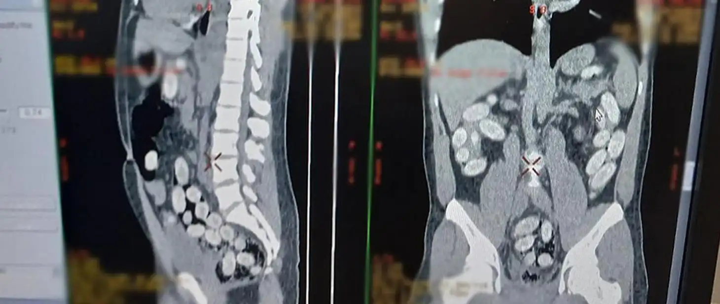 Nieudany przemyt ponad 1 kg kokainy na Lotnisku Chopina. Nigeryjczyk przemycał narkotyki w żołądku